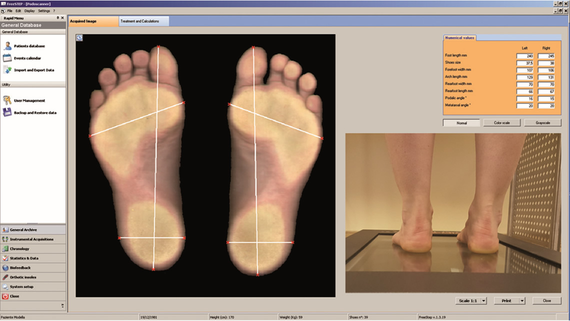 Osteoarthritis2